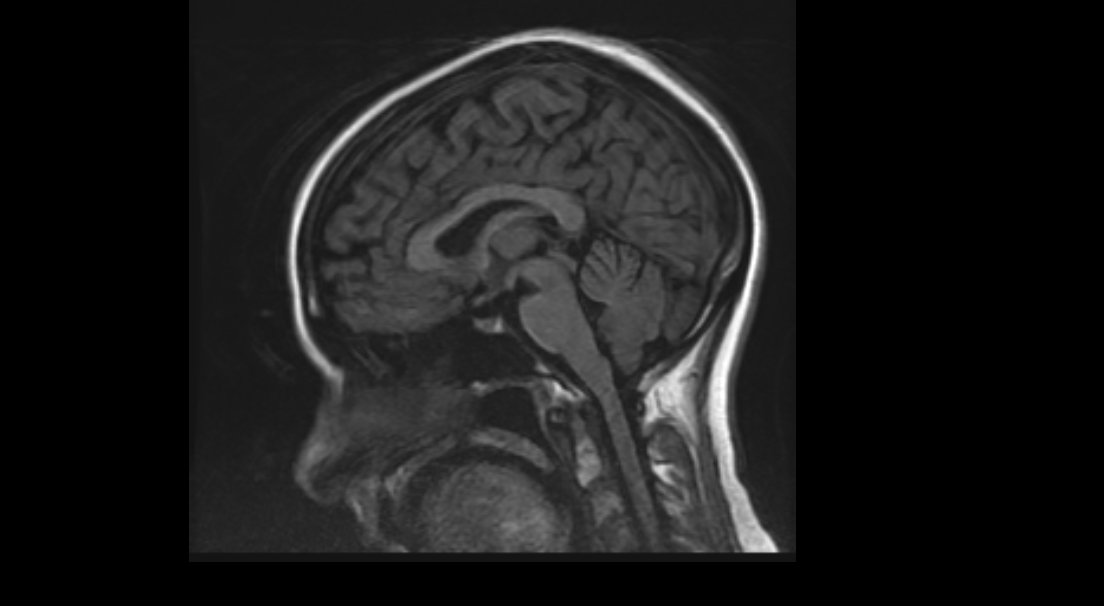 MRI image of the brain An MRI image of the brain